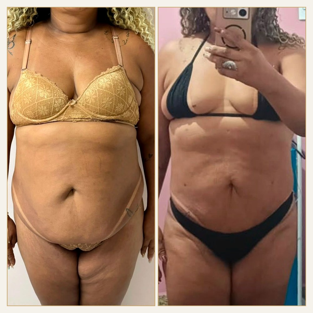 Antes & Depois