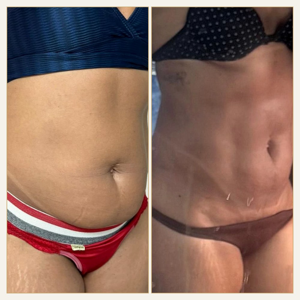 Antes & Depois
